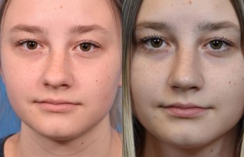 teenage girl before and after rhinoplasty - front