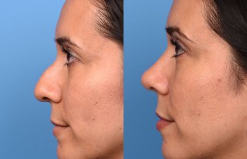 young female patient before and after rhinoplasty - left side