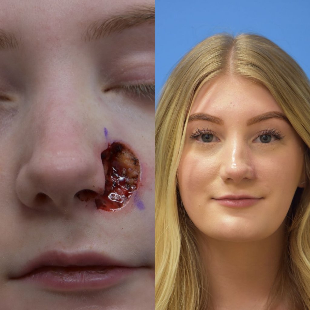 patient before and after nose MOHS reconstructive surgery