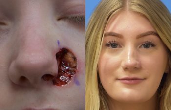 patient before and after nose MOHS reconstructive surgery