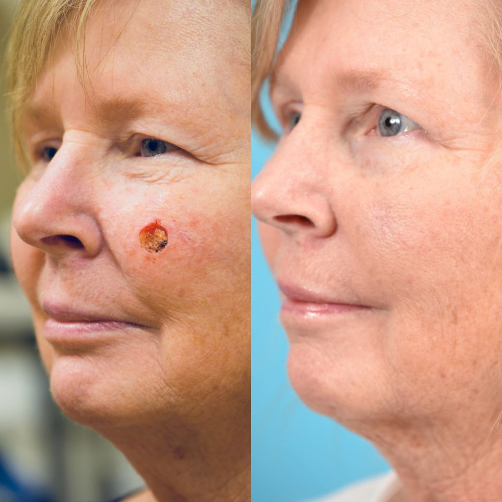 patient before and after left cheek MOHS reconstructive surgery