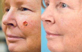 patient before and after left cheek MOHS reconstructive surgery