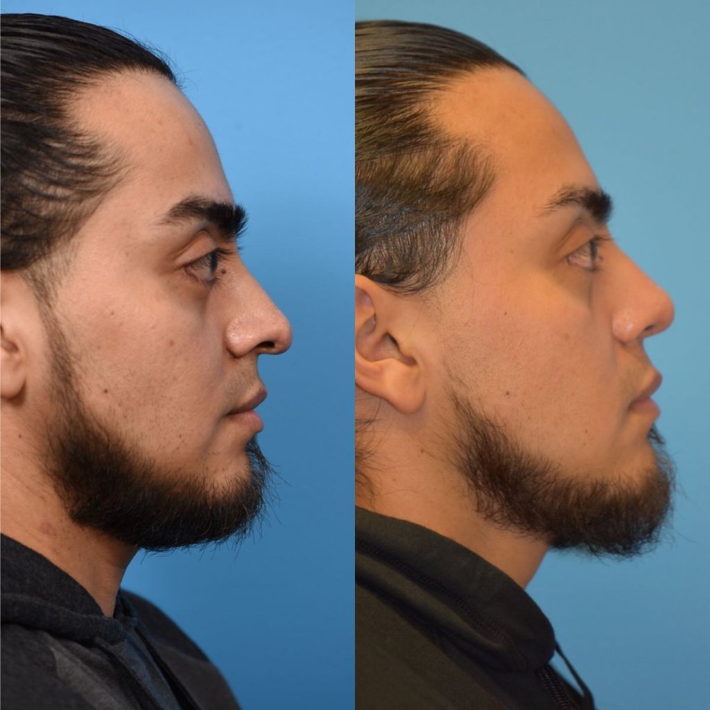 male patient before and after rhinoplasty - right side
