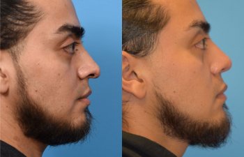 male patient before and after rhinoplasty - right side
