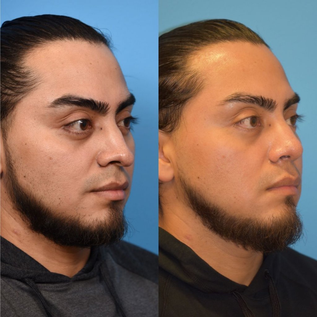male patient before and after rhinoplasty - right side