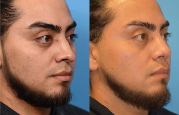 male patient before and after rhinoplasty - right side