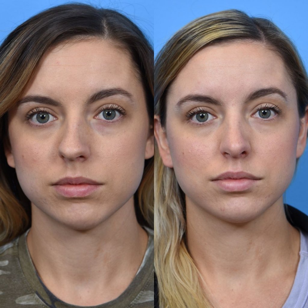 young female patient before and after rhinoplasty - front