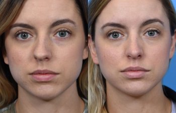 young female patient before and after rhinoplasty - front