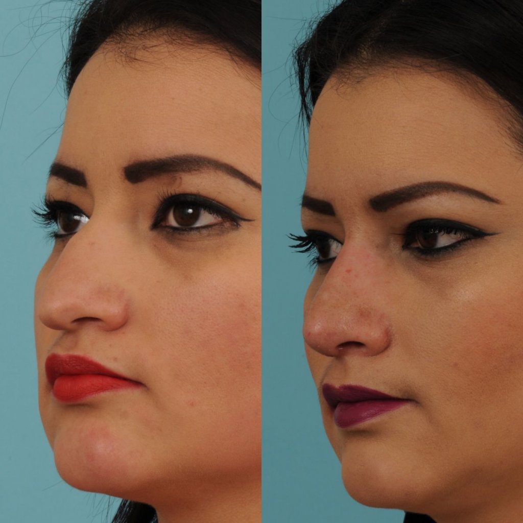 female patient before and after rhinoplasty - left side