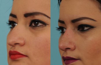 female patient before and after rhinoplasty - left side