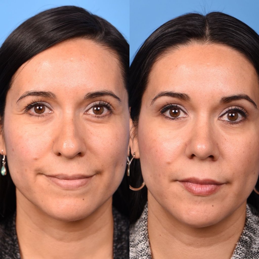 young female patient before and after rhinoplasty - front