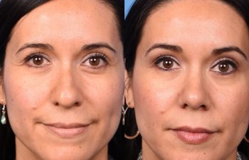 young female patient before and after rhinoplasty - front
