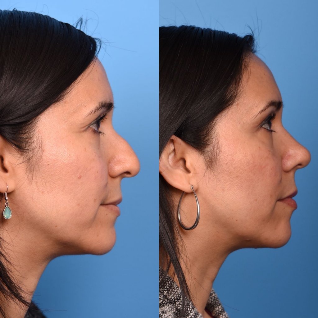 female patient before and after rhinoplasty - righ side