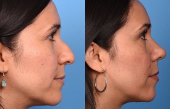 female patient before and after rhinoplasty - righ side