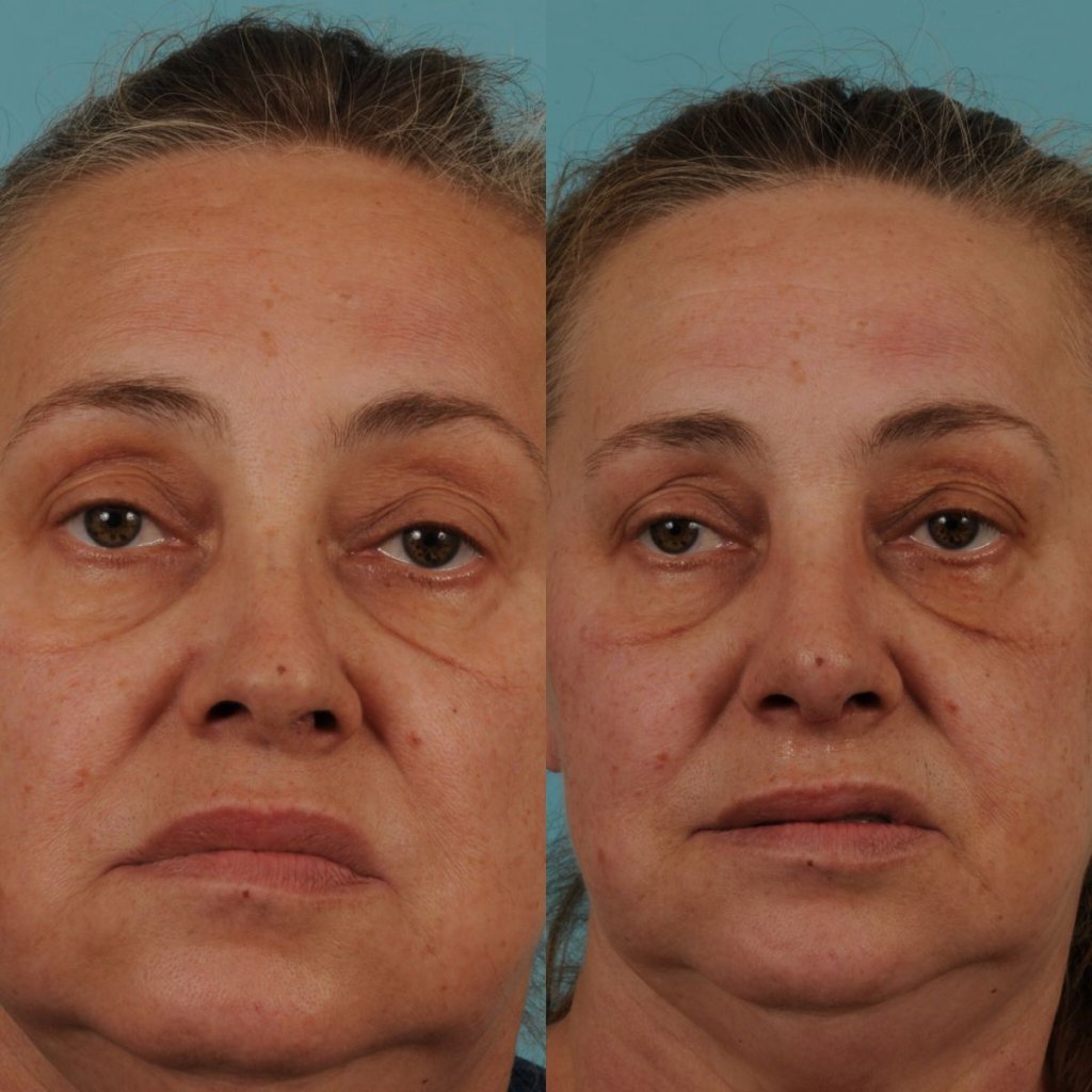female patient before and after rhinoplasty - front