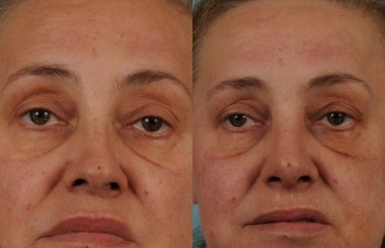 female patient before and after rhinoplasty - front