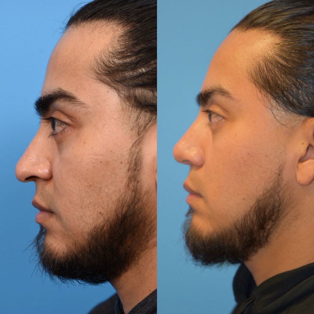 male patient before and after rhinoplasty - left side