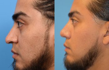 male patient before and after rhinoplasty - left side