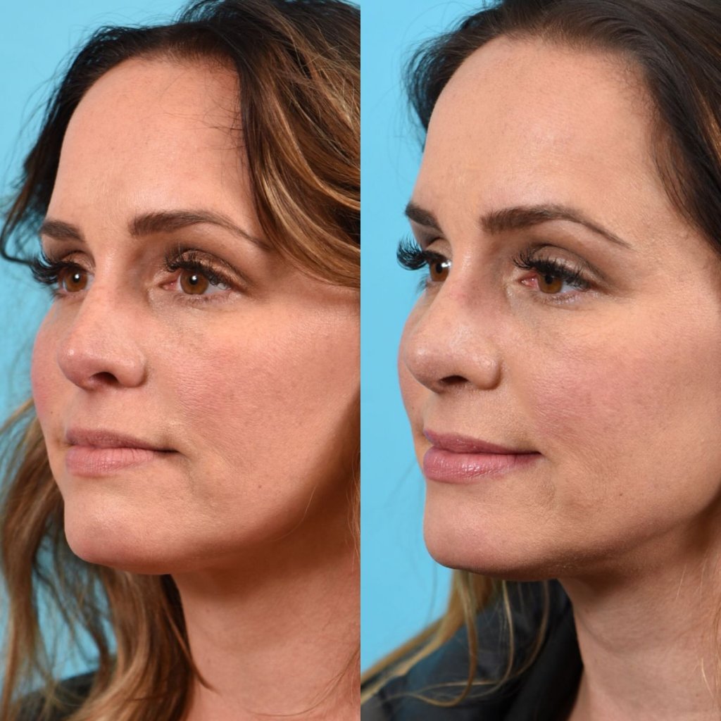 female patient before and after rhinoplasty - left side