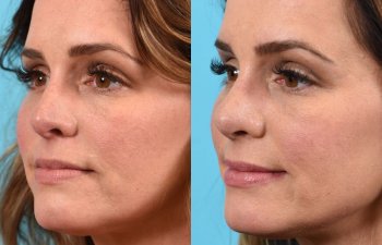 female patient before and after rhinoplasty - left side