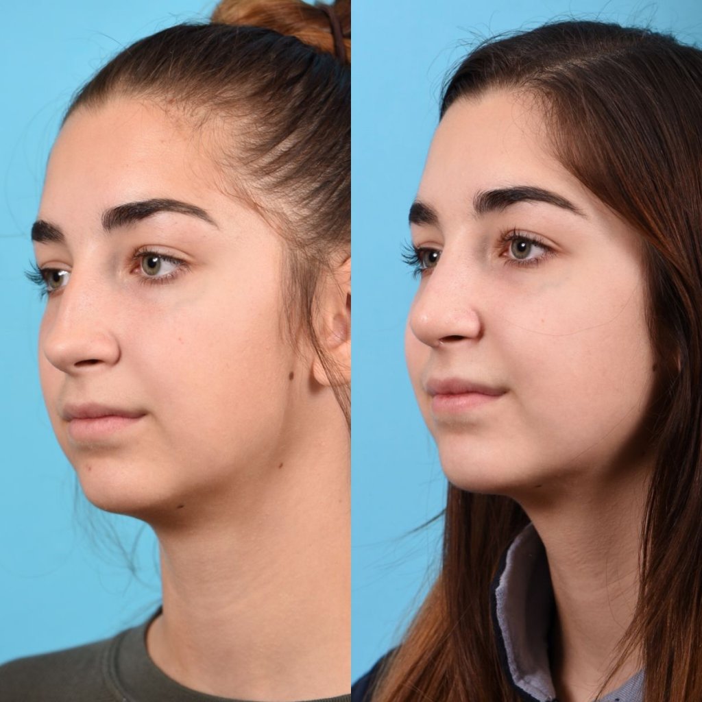 teenage female patient before and after rhinoplasty - left side