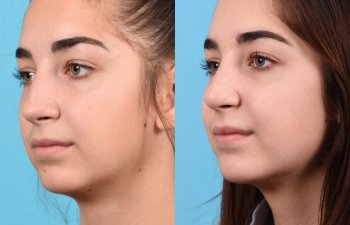 teenage female patient before and after rhinoplasty - left side