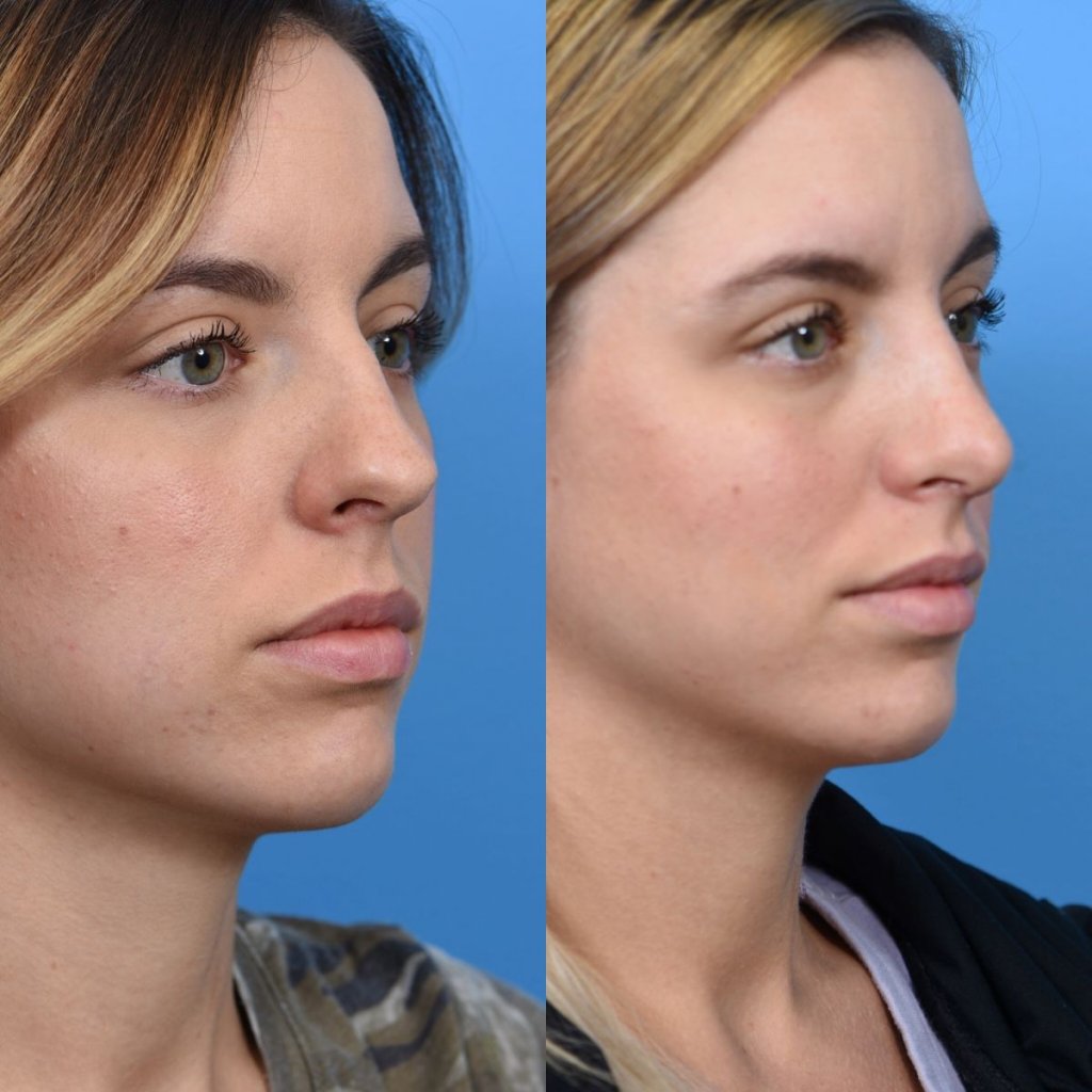 young female patient before and after rhinoplasty - righ side