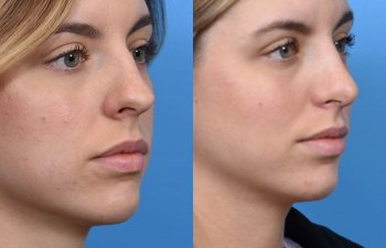 young female patient before and after rhinoplasty - righ side