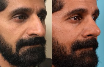 male patient before and after rhinoplasty - right side