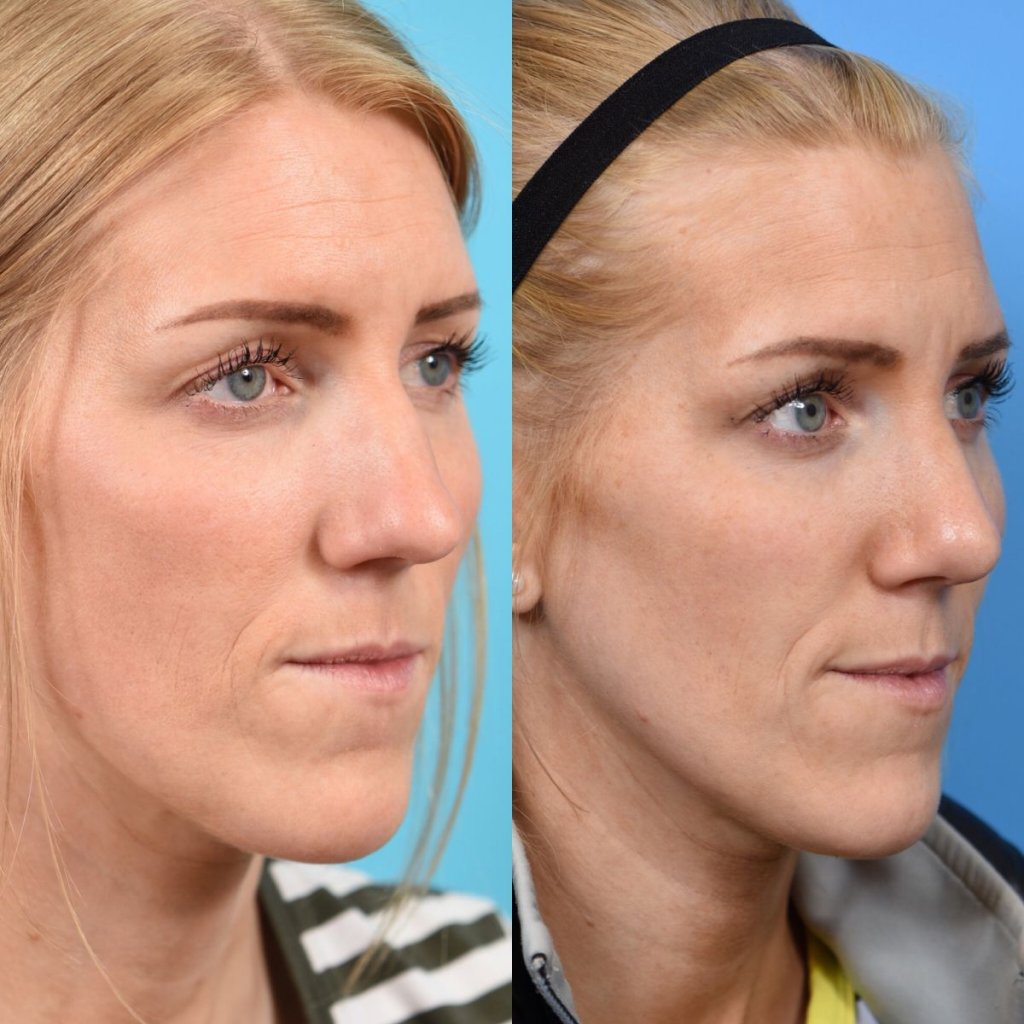female patient before and after rhinoplasty - right side
