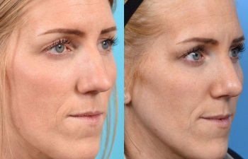 female patient before and after rhinoplasty - right side
