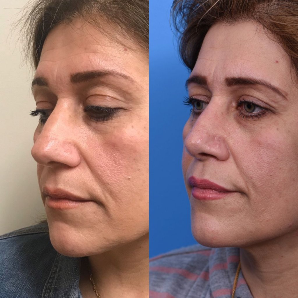 female patient before and after rhinoplasty - left side