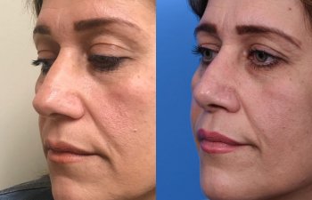 female patient before and after rhinoplasty - left side
