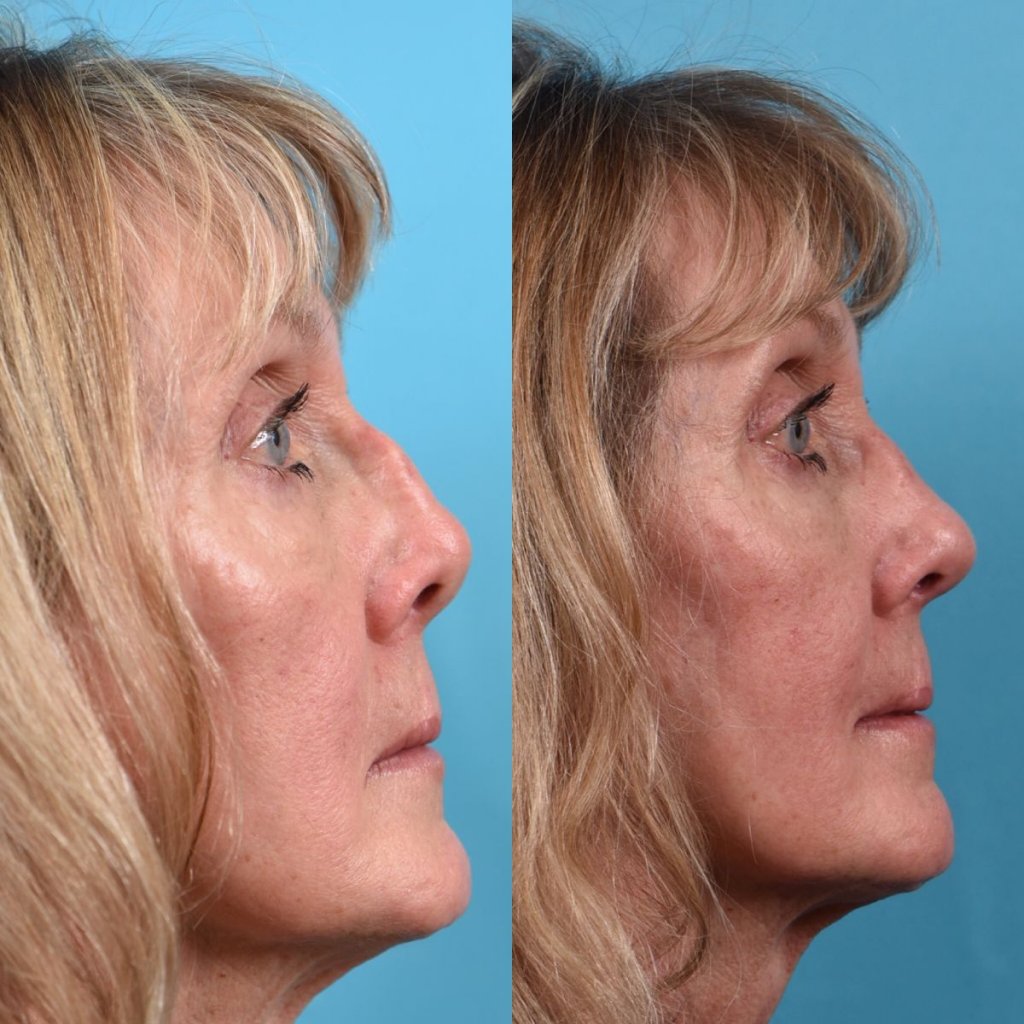 female patient before and after rhinoplasty - right side