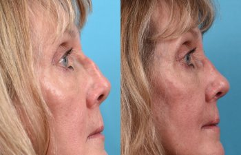 female patient before and after rhinoplasty - right side