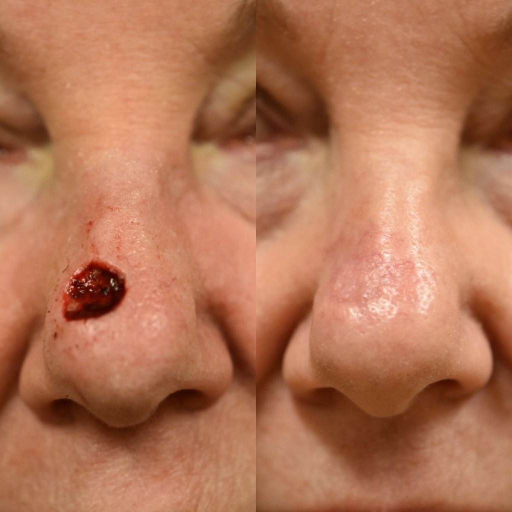 patient before and after nose MOHS reconstructive surgery