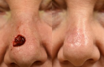 patient before and after nose MOHS reconstructive surgery