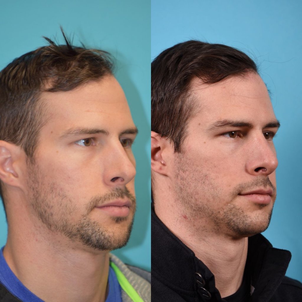 male patient before and after rhinoplasty - right side