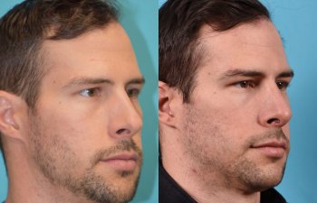 male patient before and after rhinoplasty - right side