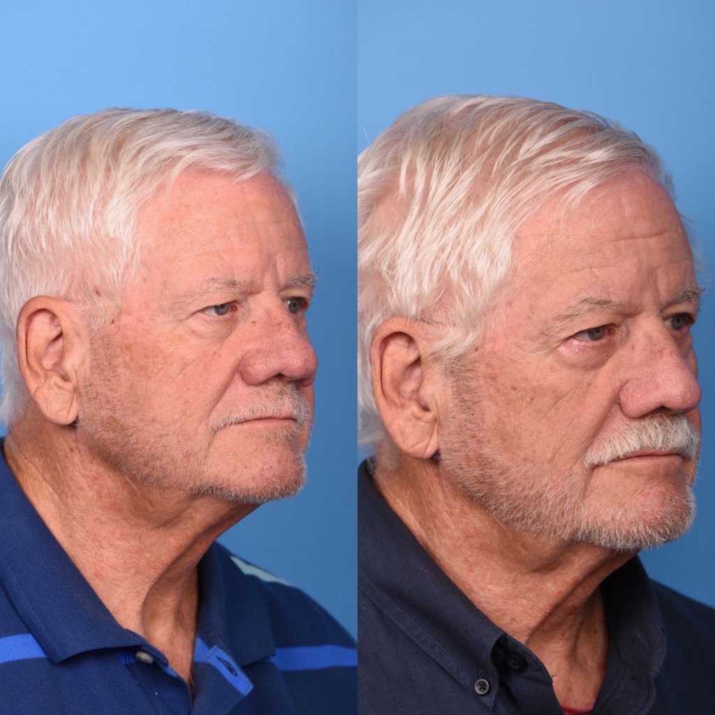 male patient before and after nasal reconstructive surgery