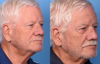 male patient before and after nasal reconstructive surgery