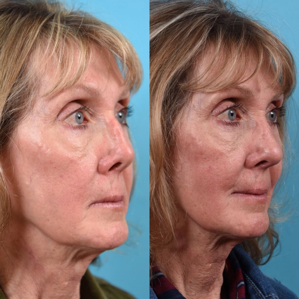 female patient before and after rhinoplasty - right side