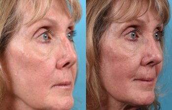 female patient before and after rhinoplasty - right side