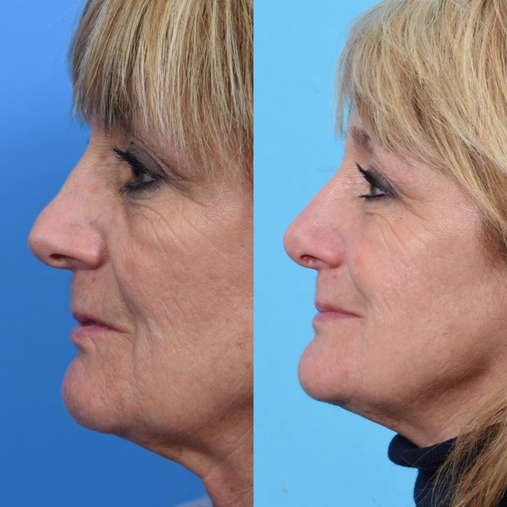 female patient before and after rhinoplasty - left side