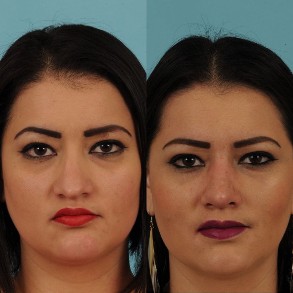 female patient before and after rhinoplasty - front