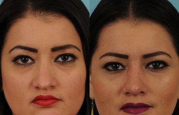 female patient before and after rhinoplasty - front