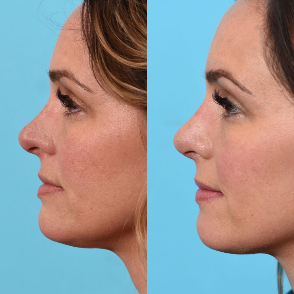 female patient before and after rhinoplasty - left side