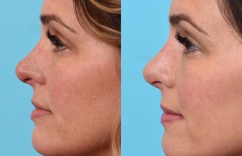 female patient before and after rhinoplasty - left side