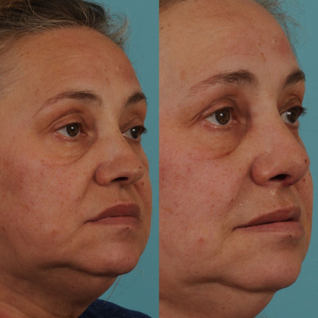female patient before and after rhinoplasty - right side