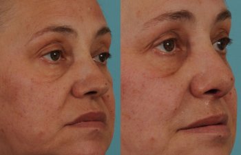 female patient before and after rhinoplasty - right side